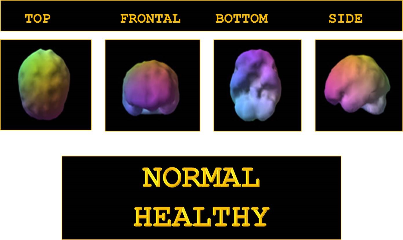 Normal healthy brain